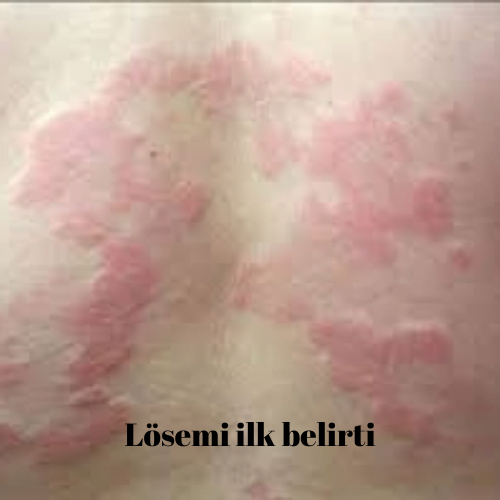 LÖSEMİ HASTALARINDA İKİNCİ EVRE