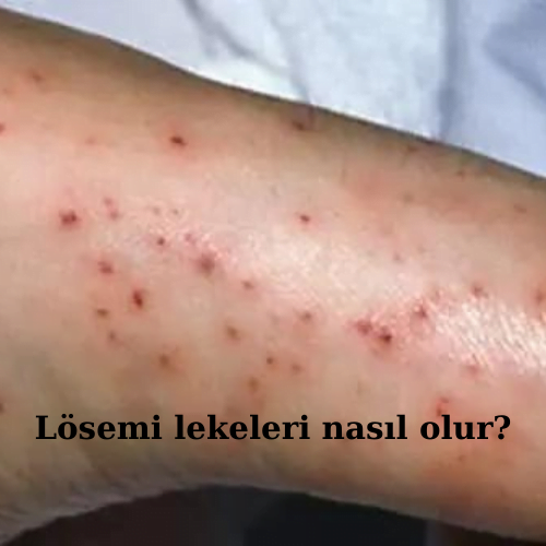Lösemi lekeleri nasıl olur?