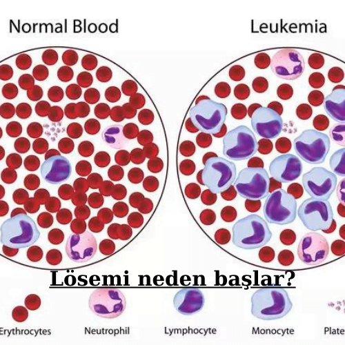 Lösemi neden başlar?